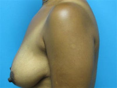 Breast Lift Before & After Gallery - Patient 132965 - Image 1