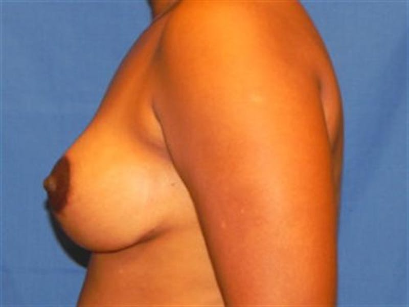 Breast Lift Before & After Gallery - Patient 132965 - Image 2