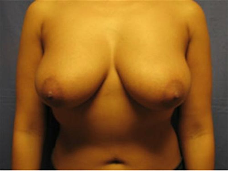 Breast Lift Before & After Gallery - Patient 394694 - Image 1
