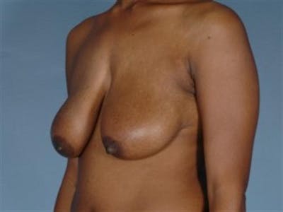 Breast Lift Before & After Gallery - Patient 412095 - Image 1