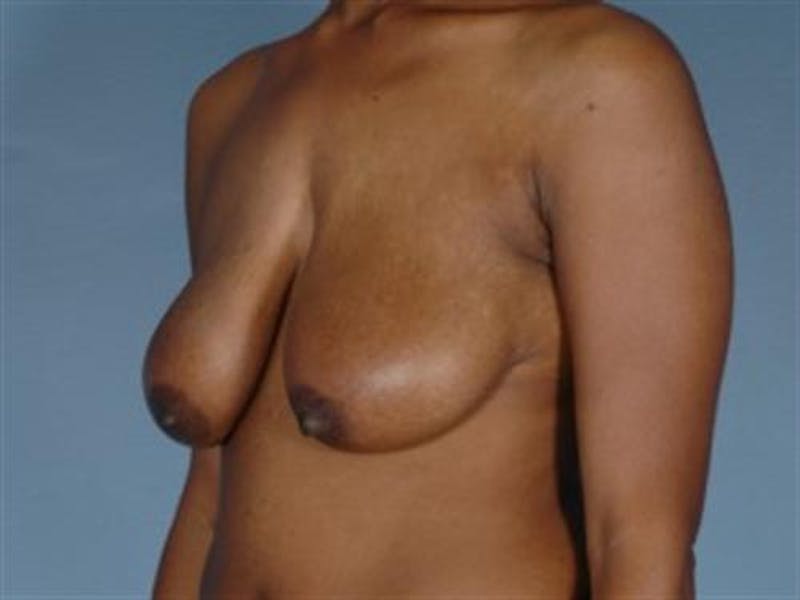 Breast Lift Before & After Gallery - Patient 412095 - Image 1