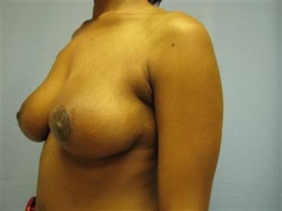 Breast Lift Before & After Gallery - Patient 412095 - Image 2
