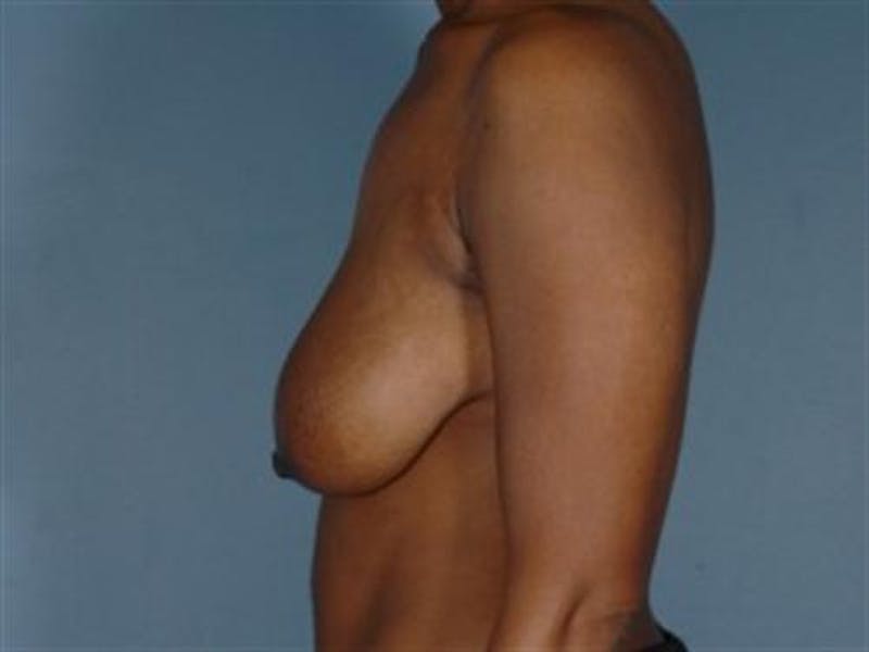 Breast Lift Before & After Gallery - Patient 412095 - Image 3