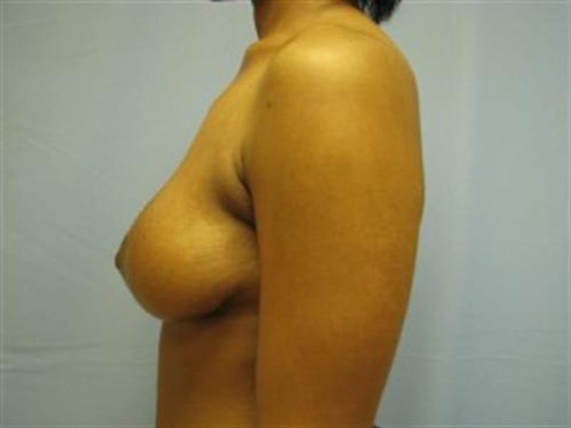 Breast Lift Before & After Gallery - Patient 412095 - Image 4