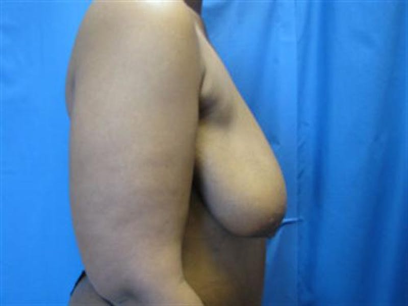Breast Lift Before & After Gallery - Patient 214241 - Image 1