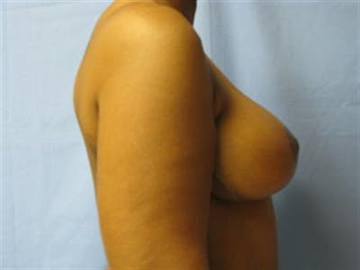 Breast Lift Before & After Gallery - Patient 214241 - Image 2