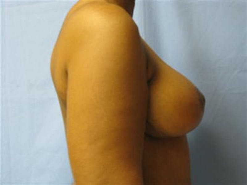 Breast Lift Before & After Gallery - Patient 214241 - Image 2