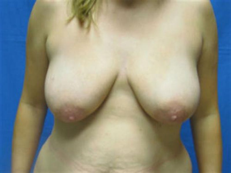 Breast Lift Before & After Gallery - Patient 143877 - Image 1