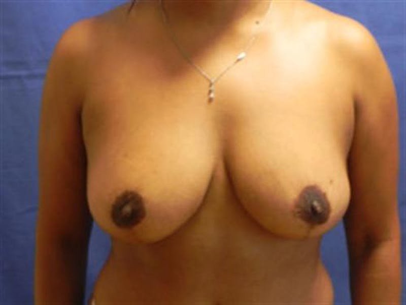Breast Lift Before & After Gallery - Patient 320956 - Image 2