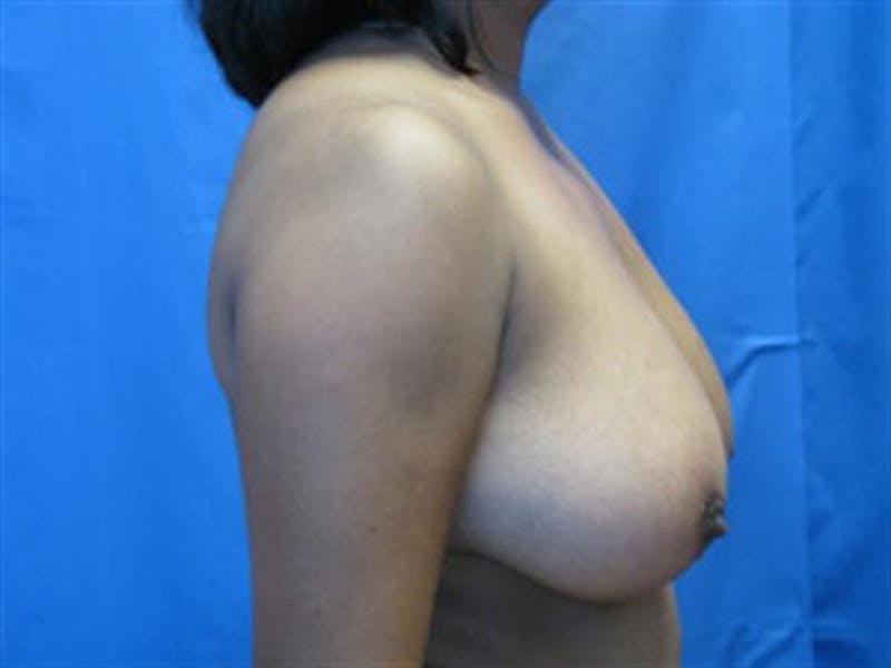 Breast Lift Before & After Gallery - Patient 320956 - Image 3