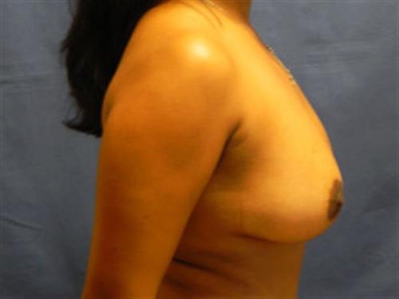 Breast Lift Before & After Gallery - Patient 320956 - Image 4