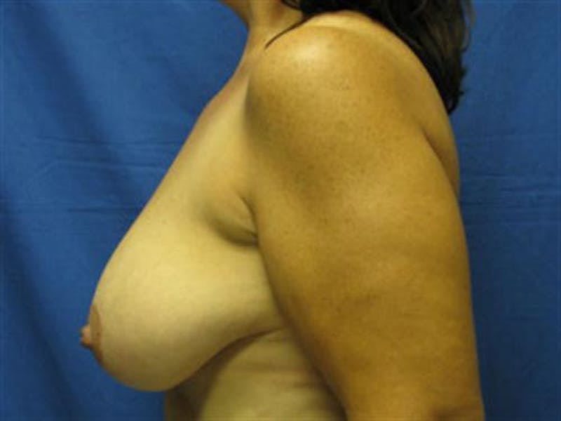Breast Lift Before & After Gallery - Patient 399181 - Image 5
