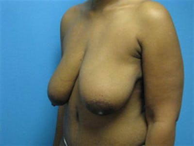 Breast Lift Before & After Gallery - Patient 288095 - Image 1