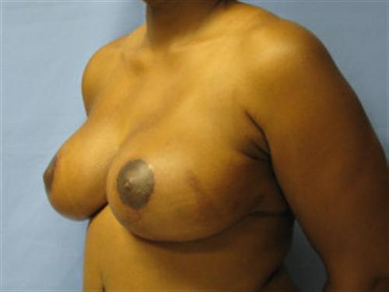 Breast Lift Before & After Gallery - Patient 288095 - Image 2