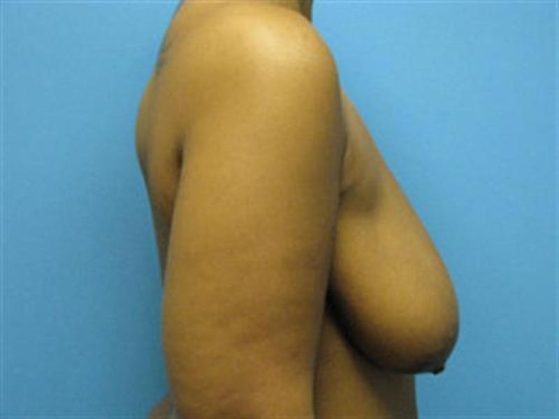 Breast Lift Before & After Gallery - Patient 288095 - Image 3