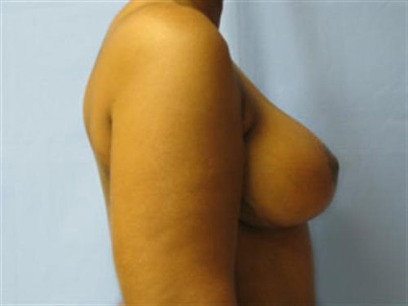 Breast Lift Before & After Gallery - Patient 288095 - Image 4