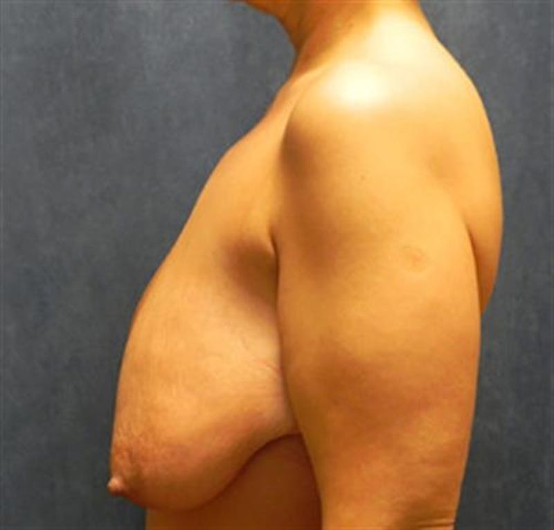 Breast Lift Before & After Gallery - Patient 701149 - Image 1