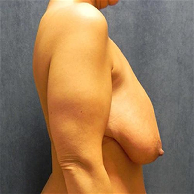 Breast Lift Before & After Gallery - Patient 701149 - Image 5