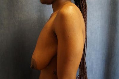 Breast Lift Before & After Gallery - Patient 421928 - Image 1