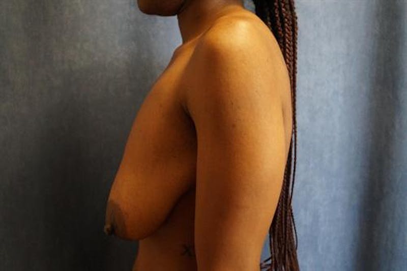 Breast Lift Before & After Gallery - Patient 421928 - Image 1