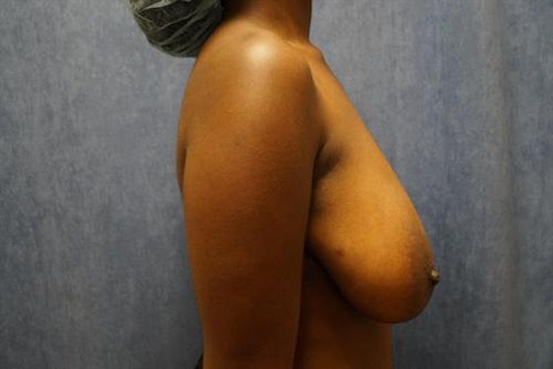 Breast Lift Before & After Gallery - Patient 312796 - Image 3