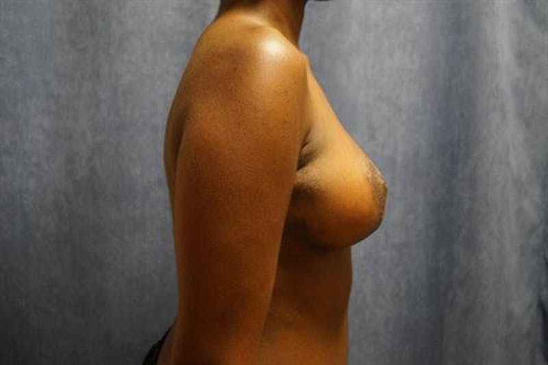 Breast Lift Before & After Gallery - Patient 312796 - Image 4
