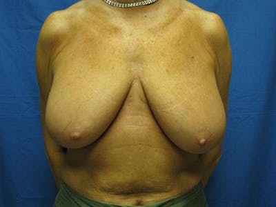 Breast Lift Before & After Gallery - Patient 429342 - Image 1