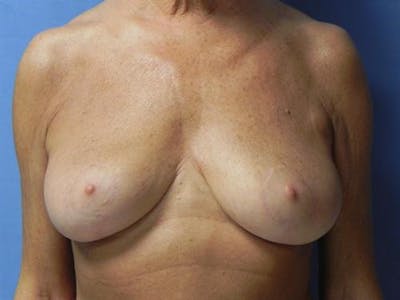 Breast Lift Before & After Gallery - Patient 429342 - Image 2