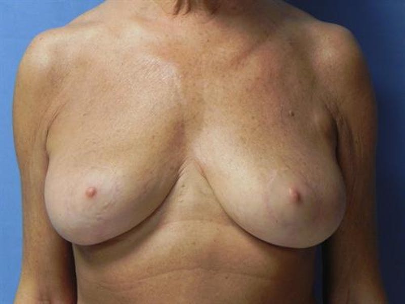 Breast Lift Before & After Gallery - Patient 429342 - Image 2