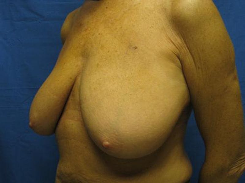 Breast Lift Before & After Gallery - Patient 429342 - Image 3
