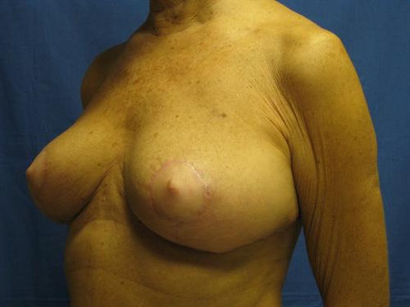 Breast Lift Before & After Gallery - Patient 429342 - Image 4