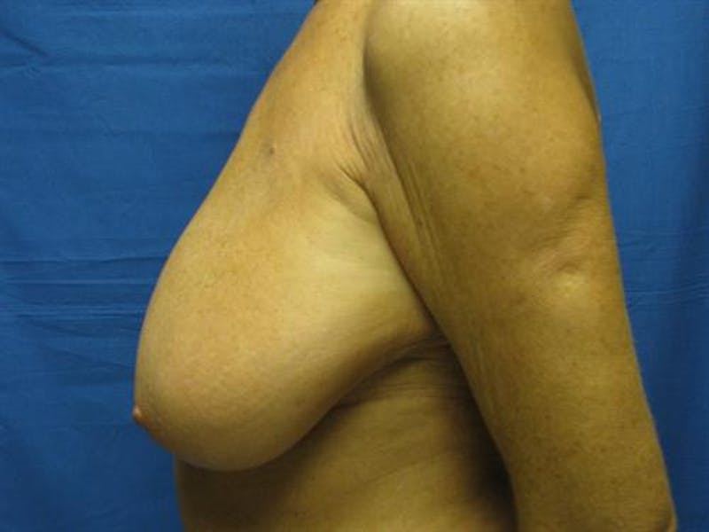 Breast Lift Before & After Gallery - Patient 429342 - Image 5
