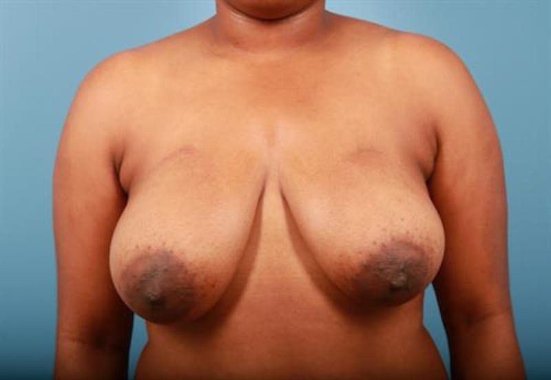 Breast Asymmetry Correction Before & After Gallery - Patient 356682 - Image 1