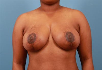 Breast Asymmetry Correction Before & After Gallery - Patient 356682 - Image 2