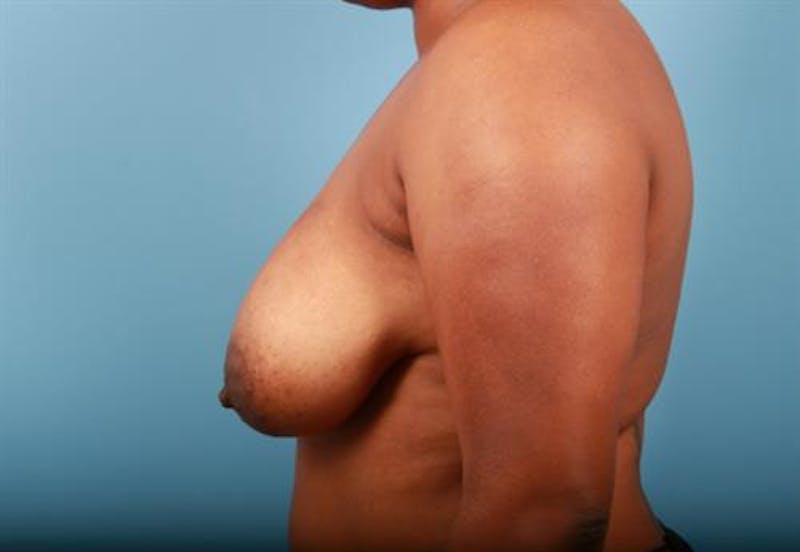 Breast Asymmetry Correction Before & After Gallery - Patient 356682 - Image 3