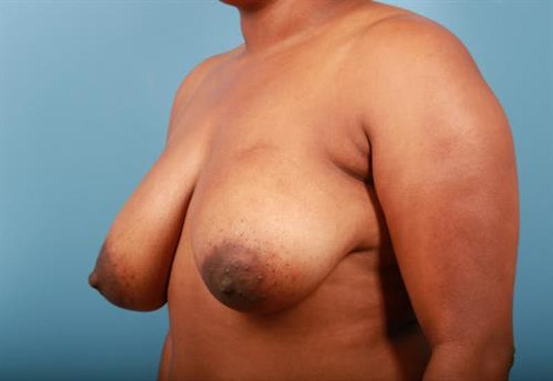 Breast Asymmetry Correction Before & After Gallery - Patient 356682 - Image 5