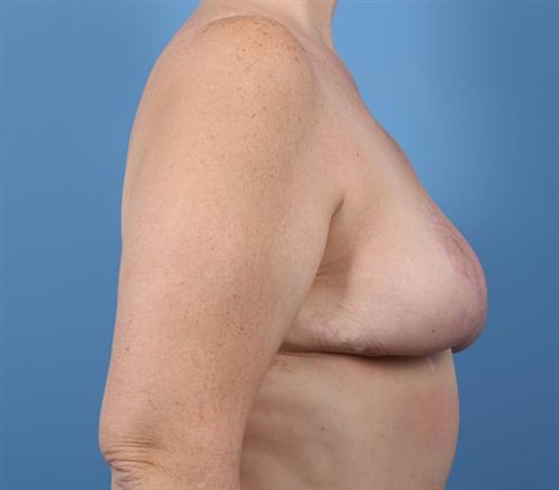 Breast Reduction Before & After Gallery - Patient 328434 - Image 4