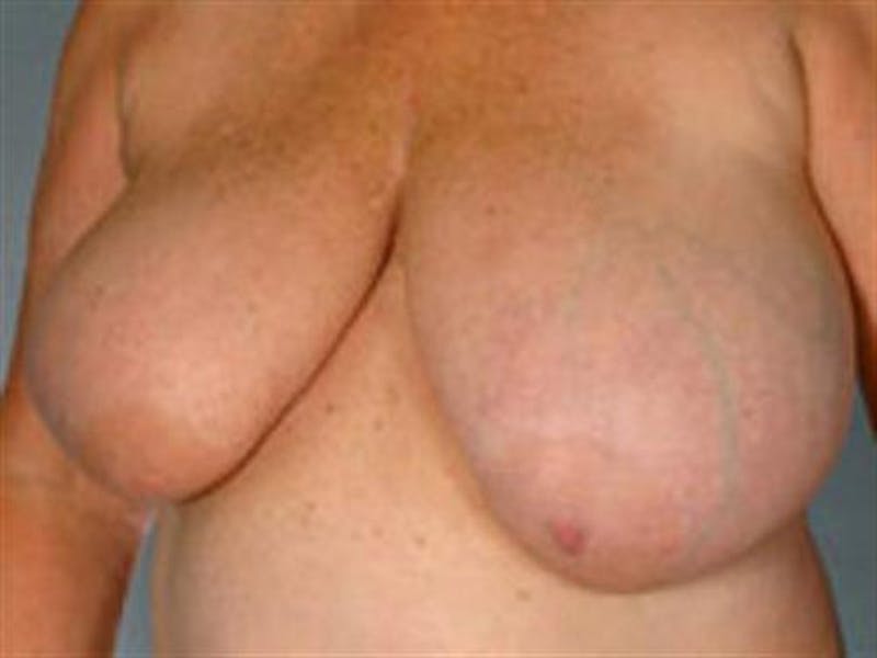 Breast Reduction Before & After Gallery - Patient 205554 - Image 1