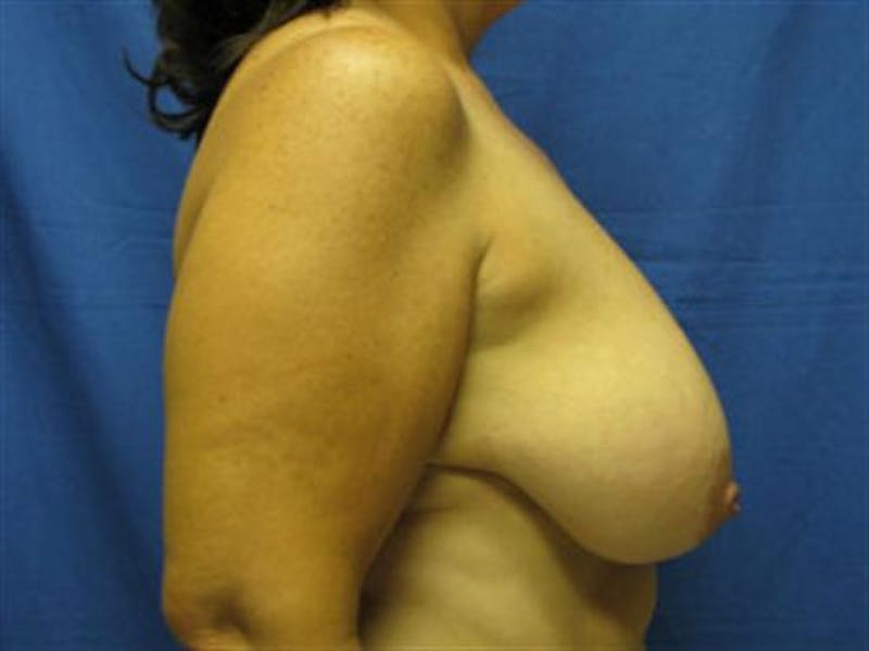 Breast Reduction Before & After Gallery - Patient 182036 - Image 3