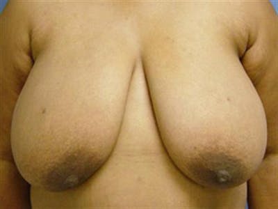 Breast Reduction Before & After Gallery - Patient 195948 - Image 1