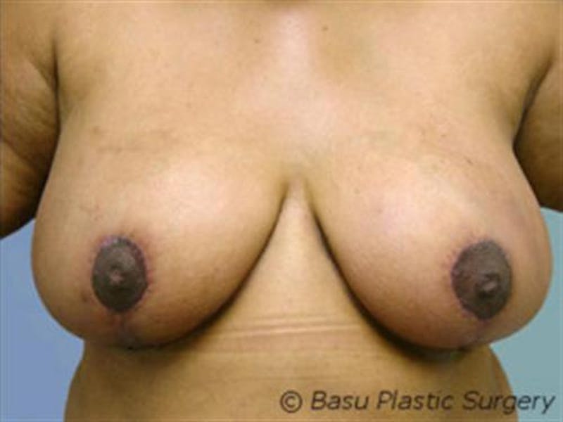 Breast Reduction Before & After Gallery - Patient 195948 - Image 2