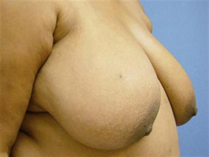 Breast Reduction Before & After Gallery - Patient 195948 - Image 3