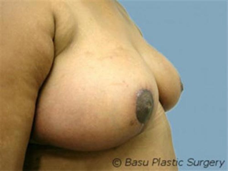 Breast Reduction Before & After Gallery - Patient 195948 - Image 4