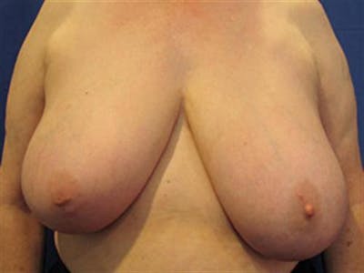 Breast Reduction Before & After Gallery - Patient 274982 - Image 1