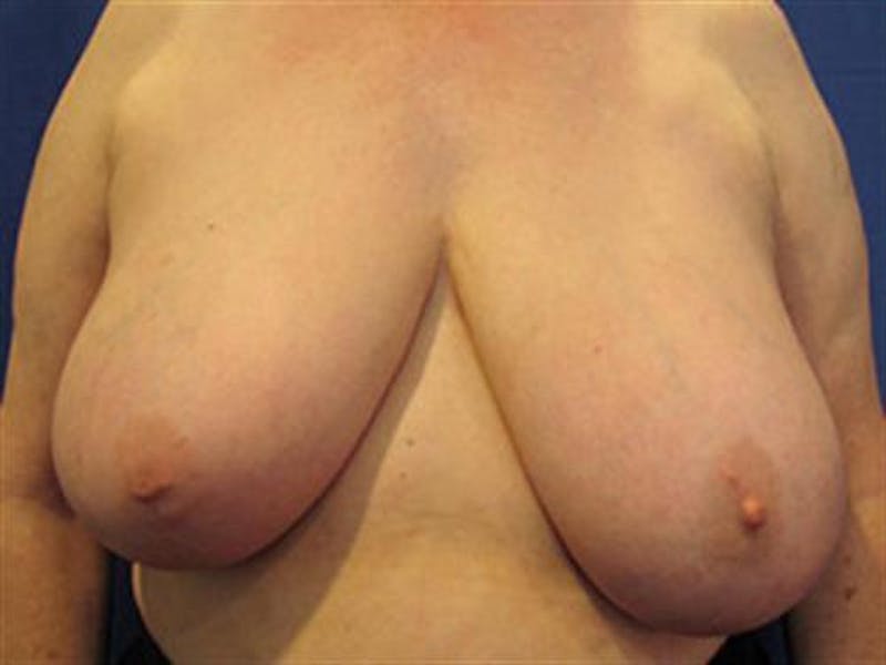 Breast Reduction Before & After Gallery - Patient 274982 - Image 1