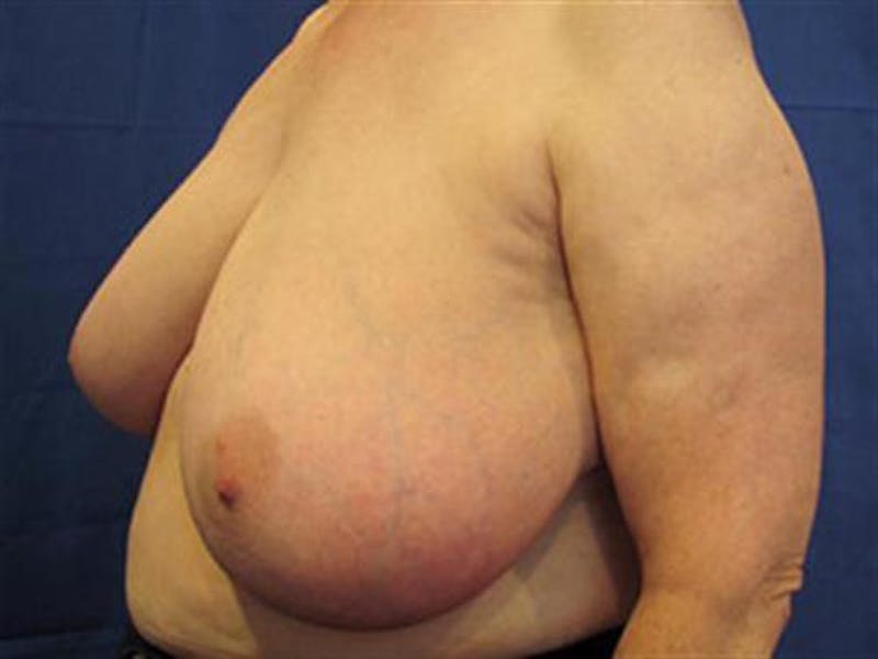 Breast Reduction Before & After Gallery - Patient 274982 - Image 3