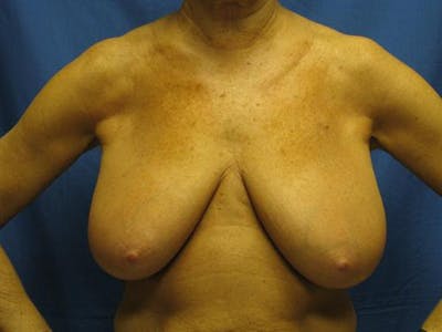 Breast Reduction Before & After Gallery - Patient 207368 - Image 1