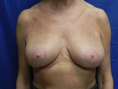 Breast Reduction Before & After Gallery - Patient 207368 - Image 2