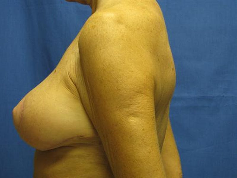 Breast Reduction Before & After Gallery - Patient 207368 - Image 4