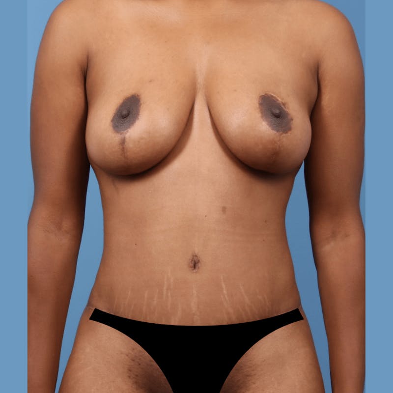 Mommy Makeover Before & After Gallery - Patient 423276 - Image 2